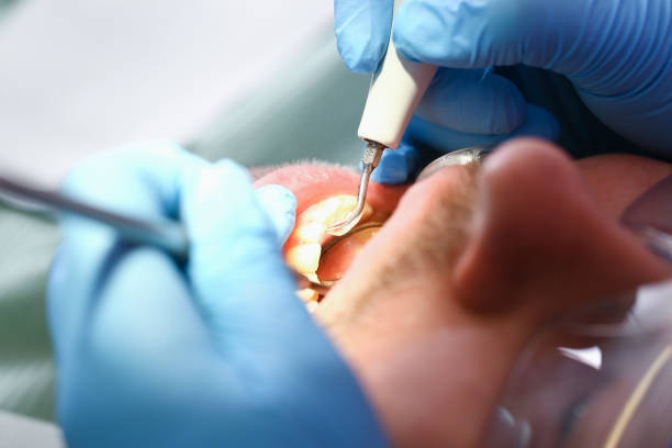 Best Emergency Tooth Extraction in Rosemount, OH